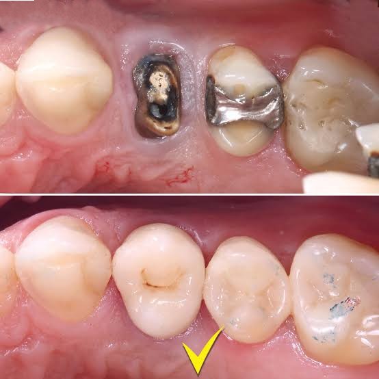 Dental Crowns
